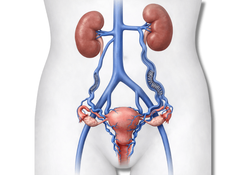 Ilustração: Varizes Pélvicas